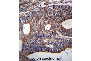 UQCRB Antibody (Center) immunohistochemistry analysis in formalin fixed and paraffin embedded human colon carcinoma followed by peroxidase conjugation of the secondary antibody and DAB staining. (UQCRB 抗体  (Middle Region))