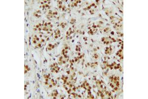 Anti-CTBP2 antibody, IHC(P) IHC(P): Human Mammary Cancer Tissue (CTBP2 抗体  (C-Term))