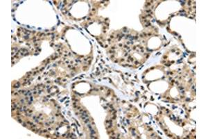 The image on the left is immunohistochemistry of paraffin-embedded Human thyroid cancer tissue using ABIN7128063(UCHL3 Antibody) at dilution 1/25, on the right is treated with fusion protein. (UCHL3 抗体)
