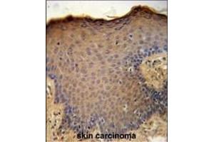 CXCL9 Antibody (C-term) (ABIN651314 and ABIN2840183) immunohistochemistry analysis in formalin fixed and paraffin embedded human skin carcinoma followed by peroxidase conjugation of the secondary antibody and DAB staining. (CXCL9 抗体  (C-Term))