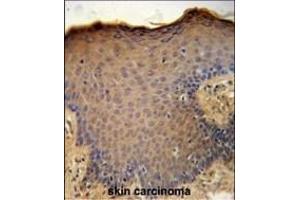 CXCL9 Antibody (C-term) (ABIN651314 and ABIN2840183) immunohistochemistry analysis in formalin fixed and paraffin embedded human skin carcinoma followed by peroxidase conjugation of the secondary antibody and DAB staining.