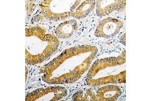 Immunohistochemical analysis of PPOX staining in human colon cancer formalin fixed paraffin embedded tissue section. (PPOX 抗体)