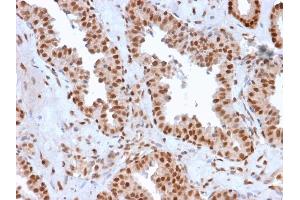 Formalin-fixed, paraffin-embedded human Prostate Carcinoma stained with APEX Nuclease I Mouse Monoclonal Antibody (CPTC-APEX1-2).
