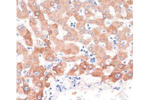 Immunohistochemistry of paraffin-embedded Human liver cancer using CHAT Polyclonal Antibody at dilution of 1:200 (40x lens). (Choline Acetyltransferase 抗体)