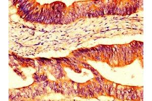IHC image of ABIN7162123 diluted at 1:400 and staining in paraffin-embedded human colon cancer performed on a Leica BondTM system. (Occludin 抗体  (AA 285-430))