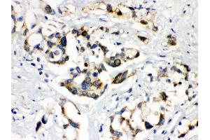 Anti- ABCB11 Picoband antibody, IHC(P) IHC(P): Human Liver Cancer Tissue (ABCB11 抗体  (C-Term))