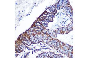 Immunohistochemistry of paraffin-embedded Human colon carcinoma using DOK4 Rabbit pAb (ABIN3020721, ABIN3020722, ABIN3020723 and ABIN6213691) at dilution of 1:100 (40x lens). (DOK4 抗体  (AA 240-326))