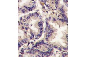 Formalin-fixed and paraffin-embedded human lung carcinoma tissue reacted with VEGF3 Antibody (Center ) (ABIN388784 and ABIN2839116) , which was peroxidase-conjugated to the secondary antibody, followed by DAB staining. (VEGFC 抗体  (AA 248-277))
