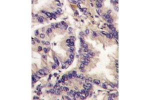 Formalin-fixed and paraffin-embedded human lung carcinoma tissue reacted with VEGF3 Antibody (Center ) (ABIN388784 and ABIN2839116) , which was peroxidase-conjugated to the secondary antibody, followed by DAB staining.
