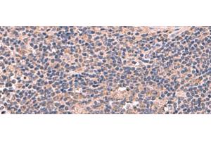Immunohistochemistry of paraffin-embedded Human cervical cancer tissue using MAGEC2 Polyclonal Antibody at dilution of 1:60(x200) (MAGEC2 抗体)