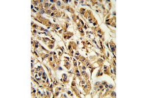 Formalin-fixed and paraffin-embedded human breast carcinoma reacted with SREBF1 Antibody (Center), which was peroxidase-conjugated to the secondary antibody, followed by DAB staining. (SREBF1 抗体  (AA 349-378))