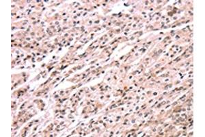 The image on the left is immunohistochemistry of paraffin-embedded Human prostate cancer tissue using ABIN7190608(EXTL1 Antibody) at dilution 1/20, on the right is treated with synthetic peptide. (EXTL1 抗体)