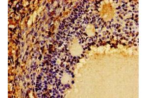 Immunohistochemistry of paraffin-embedded human ovarian cancer using ABIN7149290 at dilution of 1:100 (CD131 抗体  (AA 492-710))