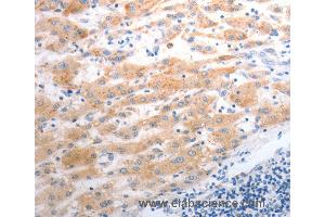Immunohistochemistry of Human liver cancer using SLC22A6 Polyclonal Antibody at dilution of 1:40