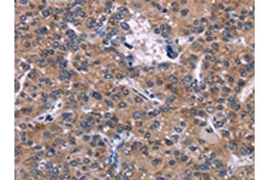 The image on the left is immunohistochemistry of paraffin-embedded Human liver cancer tissue using ABIN7192381(SKI Antibody) at dilution 1/40, on the right is treated with synthetic peptide. (SKI 抗体)