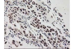 Immunohistochemical staining of paraffin-embedded Carcinoma of Human lung tissue using anti-GTF2F1 mouse monoclonal antibody. (GTF2F1 抗体)