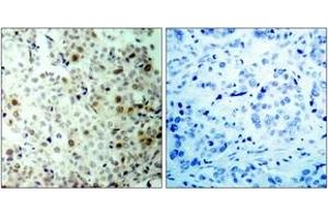 Immunohistochemistry analysis of paraffin-embedded human breast carcinoma, using CDC2 (Phospho-Thr161) Antibody.