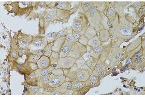 Immunohistochemistry of paraffin-embedded Human breast cancer using GGT1 Polyclonal Antibody at dilution of 1:100 (40x lens). (GGT1 抗体)