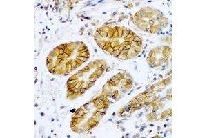 Immunohistochemical analysis of TMPRSS2 staining in human stomach cancer formalin fixed paraffin embedded tissue section. (TMPRSS2 抗体)