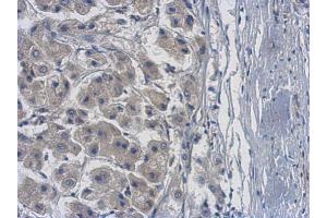 IHC-P Image Immunohistochemical analysis of paraffin-embedded human hepatoma, using PME-1, antibody at 1:500 dilution. (PPME1 抗体)