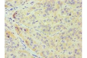 Immunohistochemistry of paraffin-embedded human liver cancer using ABIN7148700 at dilution of 1:100 (CRY1 抗体  (AA 507-586))