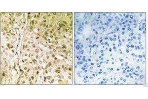 Immunohistochemistry analysis of paraffin-embedded human breast carcinoma, using DNA Polymerase thet Antibody. (POLQ 抗体  (AA 181-230))