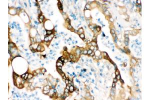 FASN was detected in paraffin-embedded sections of human intestinal cancer tissues using rabbit anti- FASN Antigen Affinity purified polyclonal antibody at 1 μg/mL. (Fatty Acid Synthase 抗体  (AA 1-226))