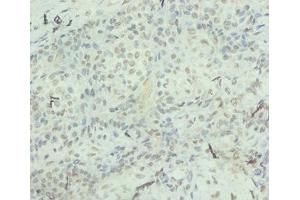 Immunohistochemistry of paraffin-embedded human breast cancer using ABIN7156933 at dilution of 1:100 (IL-8 抗体  (AA 23-99))