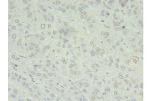 Immunohistochemistry of paraffin-embedded human liver cancer using ABIN7176040 at dilution of 1:100 (ZC3H7A 抗体  (AA 1-167))