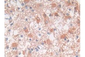 DAB staining on IHC-P; Samples: Human Glioma Tissue (FRK 抗体  (AA 234-491))