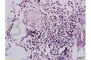 Formalin-fixed and paraffin embedded human colon carcinoma tissue with Anti-IFABP Polyclonal Antibody, Unconjugated (ABIN728173) at 1:200, followed by conjugation to the secondary antibody and DAB staining (FABP2 抗体  (AA 45-132))