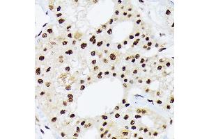 Immunohistochemistry of paraffin-embedded human liver cancer using hnRNP Q/SYNCRIP /SYNCRIP Rabbit mAb (ABIN7270673) at dilution of 1:100 (40x lens). (SYNCRIP 抗体)