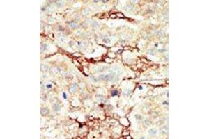 Formalin-fixed and paraffin-embedded human cancer tissue reacted with the primary antibody, which was peroxidase-conjugated to the secondary antibody, followed by DAB staining. (FGFR3 抗体  (C-Term))