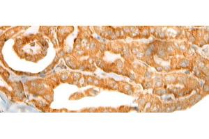Immunohistochemistry of paraffin-embedded Human thyroid cancer tissue using CEP72 Polyclonal Antibody at dilution of 1:40(x200) (CEP72 抗体)