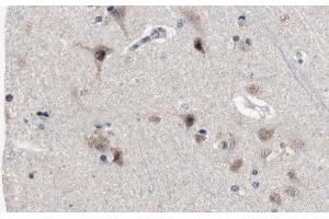 ABIN6272383 at 1/100 staining Human brain cancer tissue by IHC-P. (PDE4B/C/D 抗体)