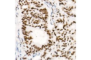 Immunohistochemistry (IHC) image for anti-SWI/SNF Related, Matrix Associated, Actin Dependent Regulator of Chromatin, Subfamily B, Member 1 (SMARCB1) antibody (ABIN7270657)