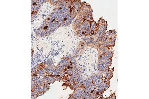 Immunohistochemical analysis of paraffin-embedded Human colon carcinoma tissue using (ABIN391544 and ABIN2841493) performed on the Leica® BOND RXm. (CEACAM5 抗体  (N-Term))