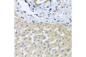 Immunohistochemistry of paraffin-embedded human liver injury using LETMD1 antibody. (LETMD1 抗体)