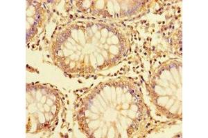 Immunohistochemistry of paraffin-embedded human colon cancer using ABIN7150132 at dilution of 1:100 (DDIT3 抗体  (AA 1-169))