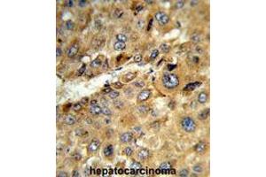 Formalin-fixed and paraffin-embedded human hepatocarcinoma reacted with TAT Antibody (Center), which was peroxidase-conjugated to the secondary antibody, followed by DAB staining. (TAT 抗体  (Middle Region))