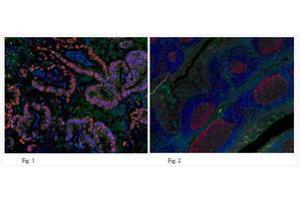 Immunofluorescent analysis of human colon adenocarcinomat tissue (Fig. (PCNA 抗体)