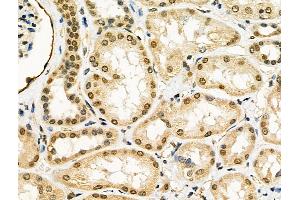 ABIN6260268 and ABIN6276437 at 1/100 staining Human kidney cancer and adjacent normal tissues by IHC-P. (BIRC2 抗体  (C-Term))