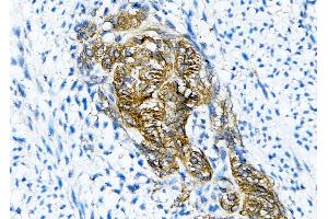 ABIN7093765 and ABIN7097799 at 1/200 staining human liver cancer tissue sections by IHC-P.