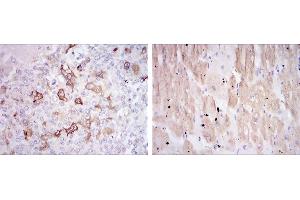Immunohistochemical analysis of paraffin-embedded breast cancer tissues (left) and cardiac muscle tissues (right) using HSP27 mouse mAb with DAB staining. (HSP27 抗体)