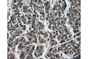 Immunohistochemical staining of paraffin-embedded Carcinoma of liver tissue using anti-GBE1mouse monoclonal antibody. (GBE1 抗体)