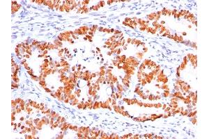 Immunohistochemistry (IHC) image for anti-Tumor Protein P53 (TP53) antibody (ABIN6940779)