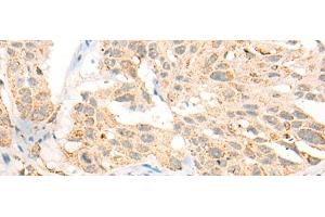 Immunohistochemistry of paraffin-embedded Human esophagus cancer tissue using CCT8L2 Polyclonal Antibody at dilution of 1:45(x200) (CCT8L2 抗体)