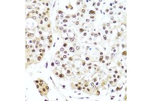 Immunohistochemistry of paraffin-embedded human colon carcinoma using TET2 antibody (ABIN6133019, ABIN6149017, ABIN6149019 and ABIN6221336) at dilution of 1:100 (40x lens). (TET2 抗体  (AA 1833-2002))
