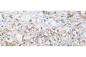 Immunohistochemistry of paraffin-embedded Human liver cancer tissue using PHPT1 Polyclonal Antibody at dilution of 1:210(x200) (PHPT1 抗体)