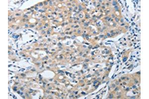 The image on the left is immunohistochemistry of paraffin-embedded Human lung cancer tissue using ABIN7128398(ANAPC13 Antibody) at dilution 1/25, on the right is treated with fusion protein.